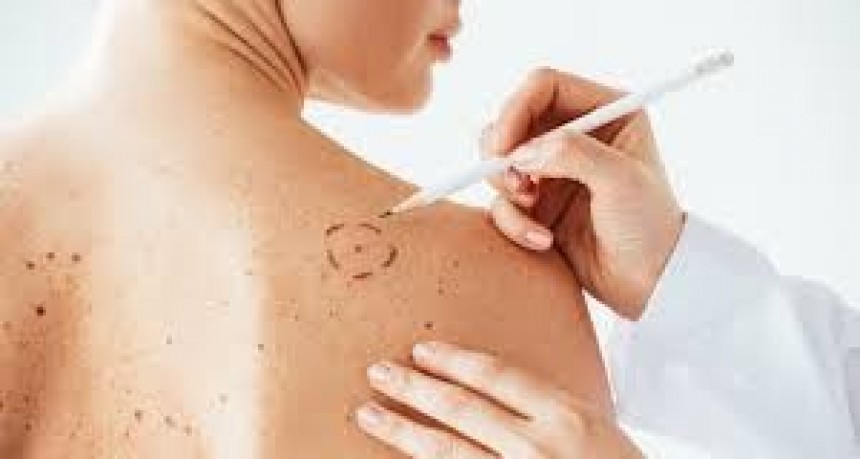 Cáncer de Piel: el poder de la genética para proteger la piel